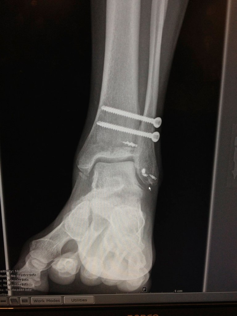 An X-ray of Marble’s left ankle shows the pins that stabilized the foot after surgery. During her ordeal, Marble decided she wanted to be a motivational speaker, where “you find the individual within the athlete.”